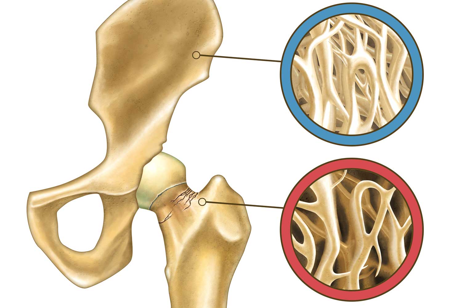 Osteoporosis